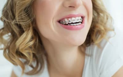 Metallbrackets: Vom Aufbau bis hin zu den Kosten der klassischen festen Spange