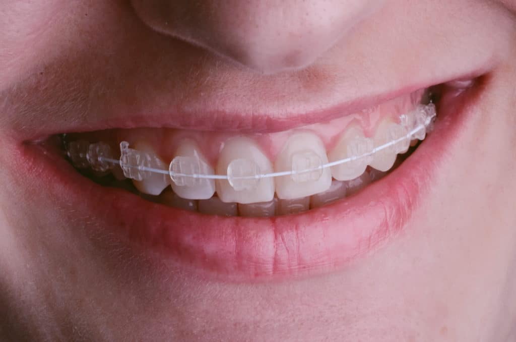 nahaufnahme einer laechelnden frau mit keramikbrackets
