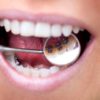 Lingual Zahnspange: Hintergründe, Vor- und Nachteile & Kosten
