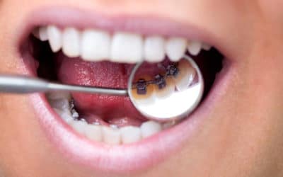 Lingual Zahnspange: Hintergründe, Vor- und Nachteile & Kosten
