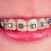 Zahnspangen Verfärbung: Ursachen und Maßnahmen