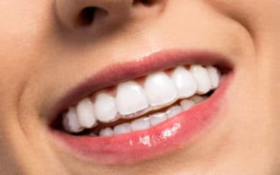 Retentionsschiene: Behandlung und Kosten des herausnehmbaren Retentionsgerätes