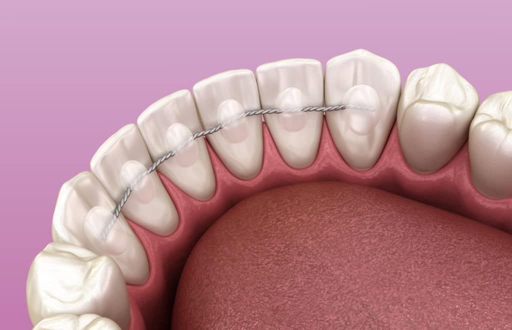 3D Ansicht des Retainers