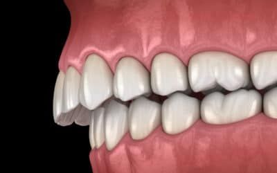 Überbiss: die richtige Behandlung von der  Zahnspange bis zur OP