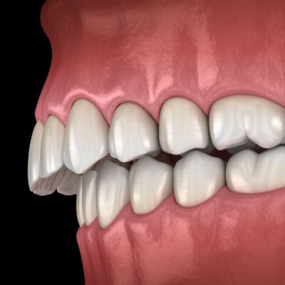 3D-Ansicht eines Überbisses
