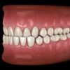 Unterbiss: Ursachen, Folgen und Behandlung der Zahn- und Kieferfehlstellung