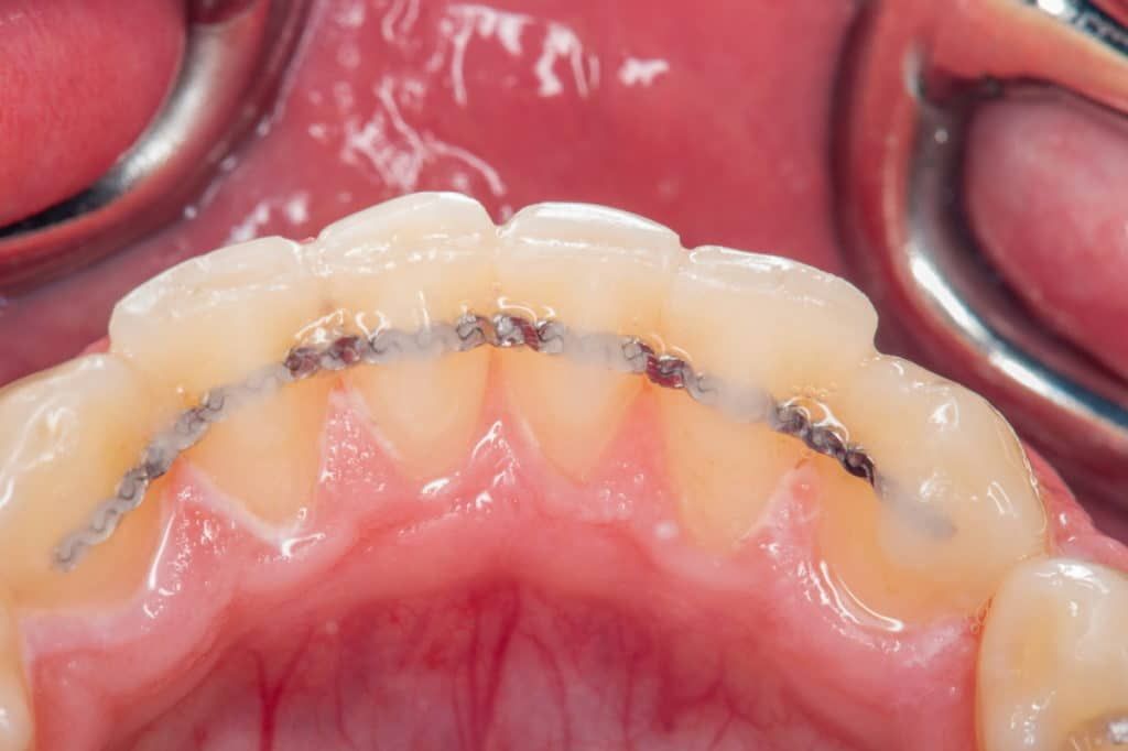 Real eingesetzer Retainer