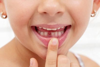 Kleines Kind mit einer Zahnlücke aufgrund des Zahnwechsels