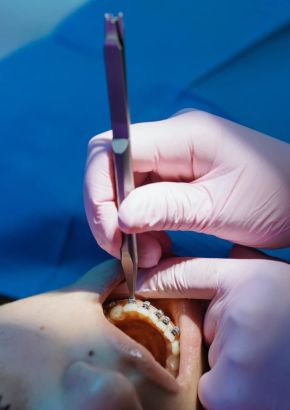 Kieferorthopäde befestigt während einer Notbehandlung ein Brackets neu