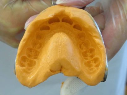 Ein Kieferorthopäde hält einen Abdrucklöffel mit einem frisch genommen Abdruck eines Patienten